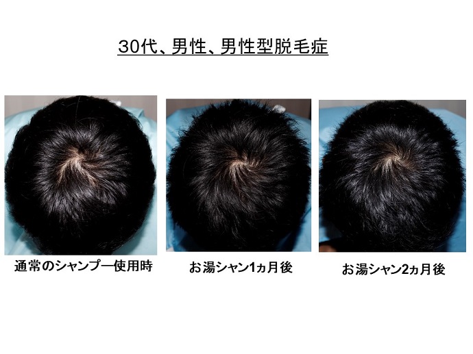 円形脱毛症　病院